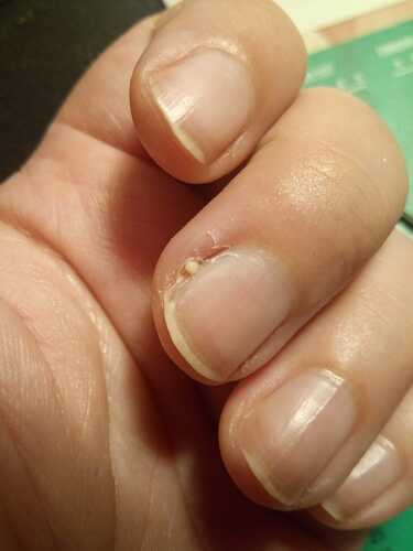 vinger