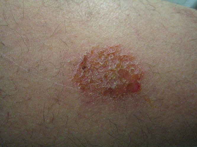 Nummulair-eczeem-en-infectie1