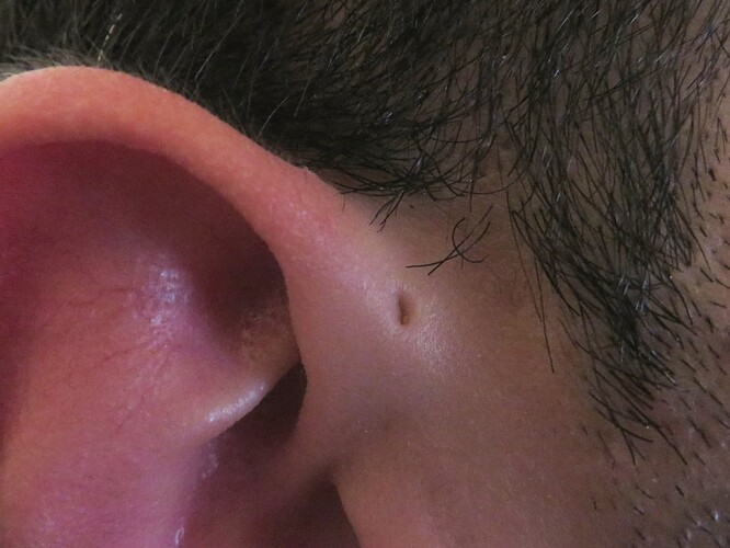 Preauricular_sinus