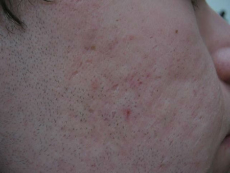 acne2maandnaco2fractre-1468575411