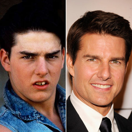 TCteeth