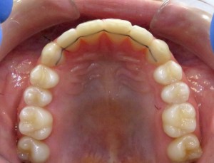 retentiebeugel-ortho-heerlen-2-300x229