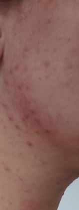 acne%20gezicht%20en%20nek