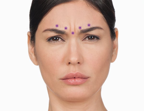 fronsrimpels-botox-600x462